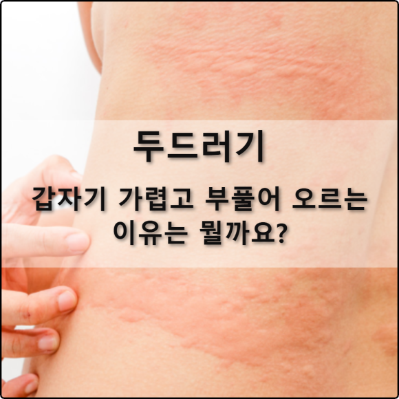 두드러기, 갑자기 가렵고 부풀어 오르는 이유는 뭘까요?