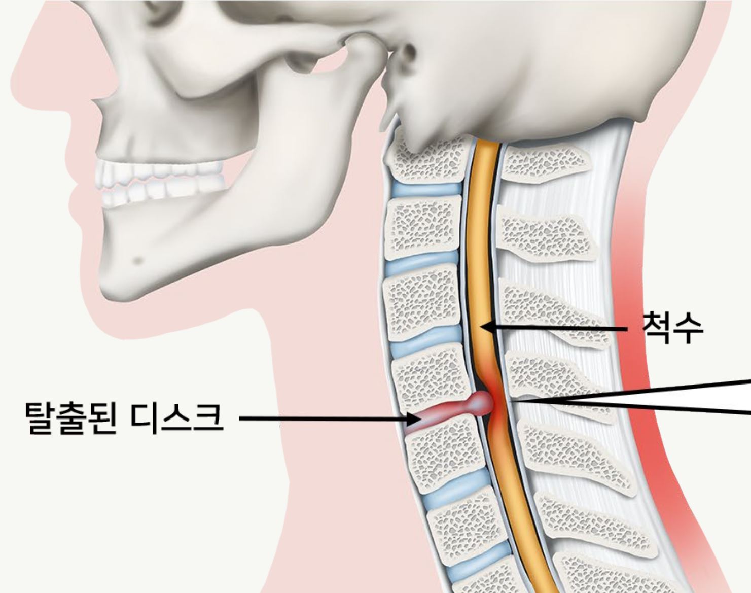 거북목, 방치하면 디스크까지 온다는 사실 아시나요?