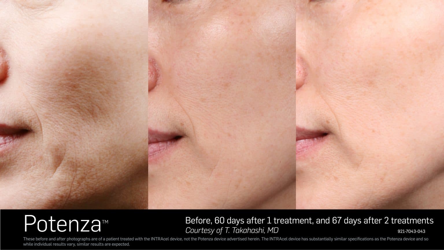 The Power Couple of Skin Rejuvenation: Unlocking Next-Level Results with Potenza™ RF Microneedling and Exosome Therapy