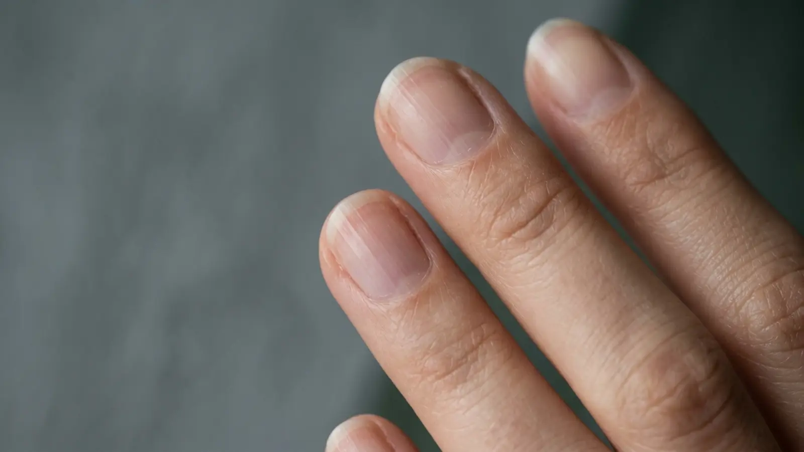 Stries Verticales Ongles : Guide Clinique & Nivellement